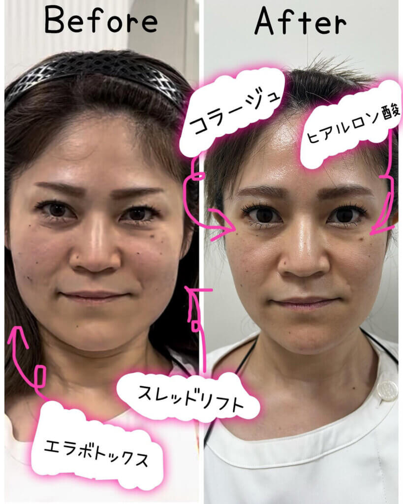 糸リフトとヒアルロン酸とコラーゲン注射とエラボトックスを同時に行った症例写真