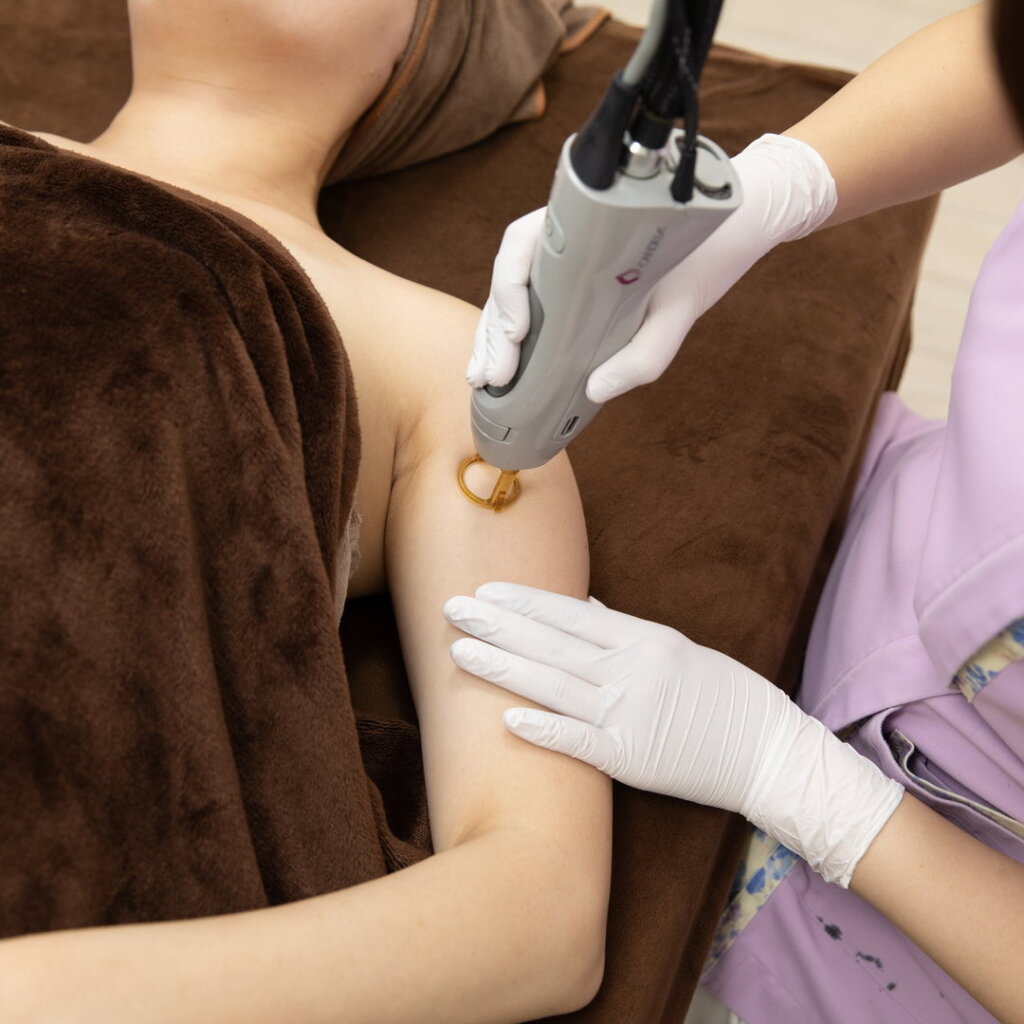 二の腕の脱毛の施術をしている様子