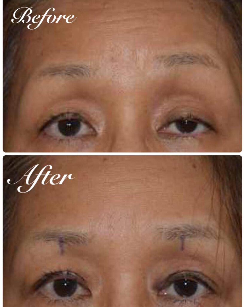 眼瞼下垂の症例