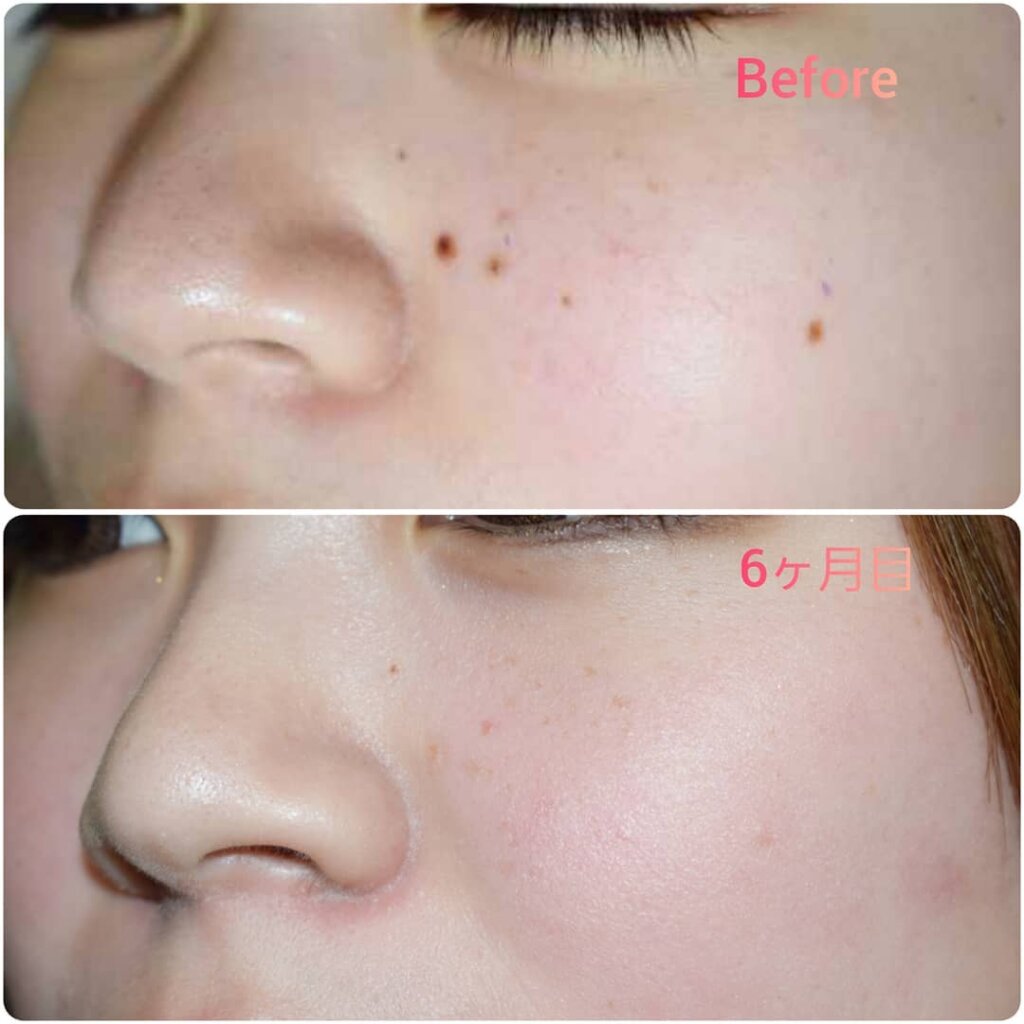 ホクロを除去した術前と6か月後の症例写真