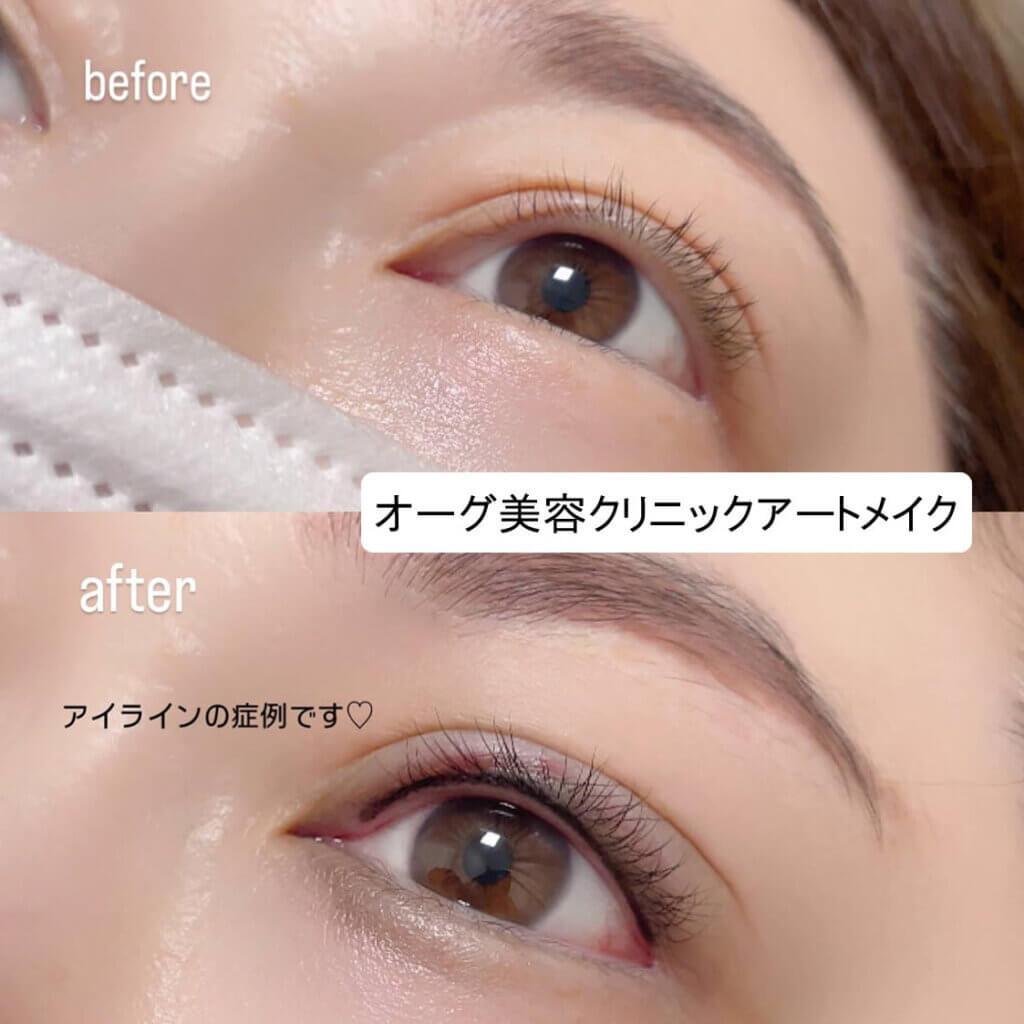 アイラインのアートメイクの症例写真