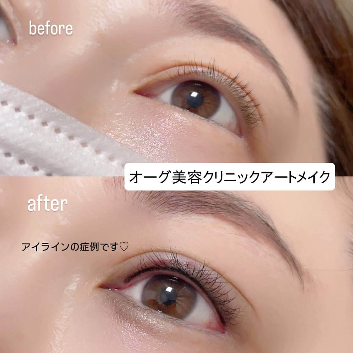 アイラインのアートメイクの症例写真