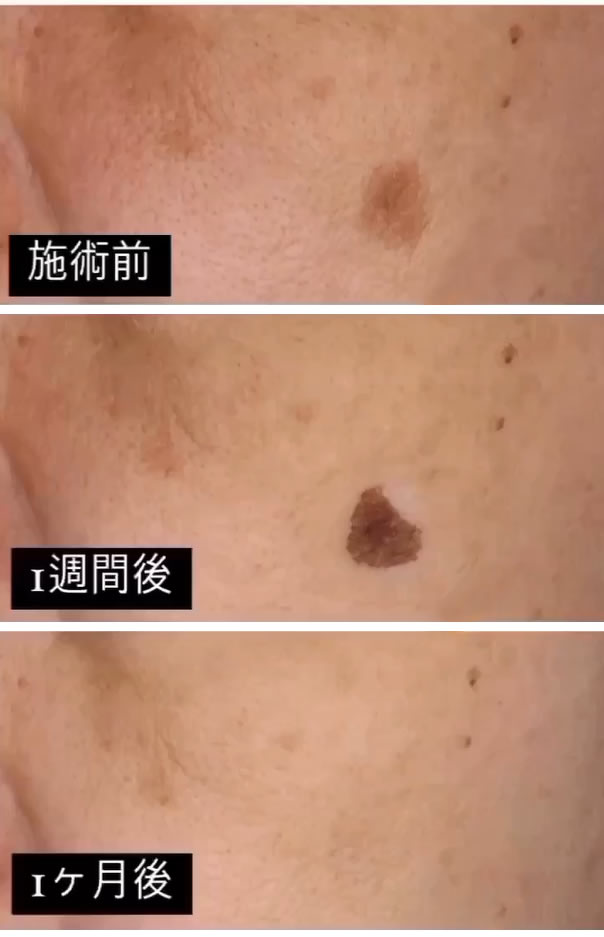オーグ美容クリニックのシミの症例写真