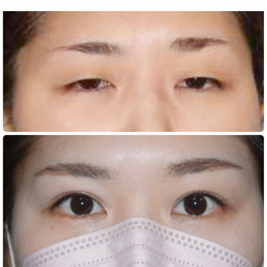 春山クリニックの眼瞼下垂の症例