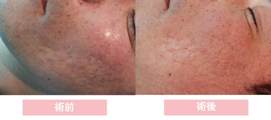ケミカルピーリング5回の症例写真