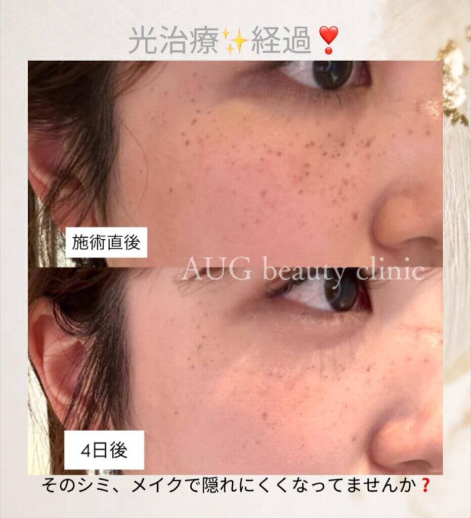 セレックVの４日後の症例