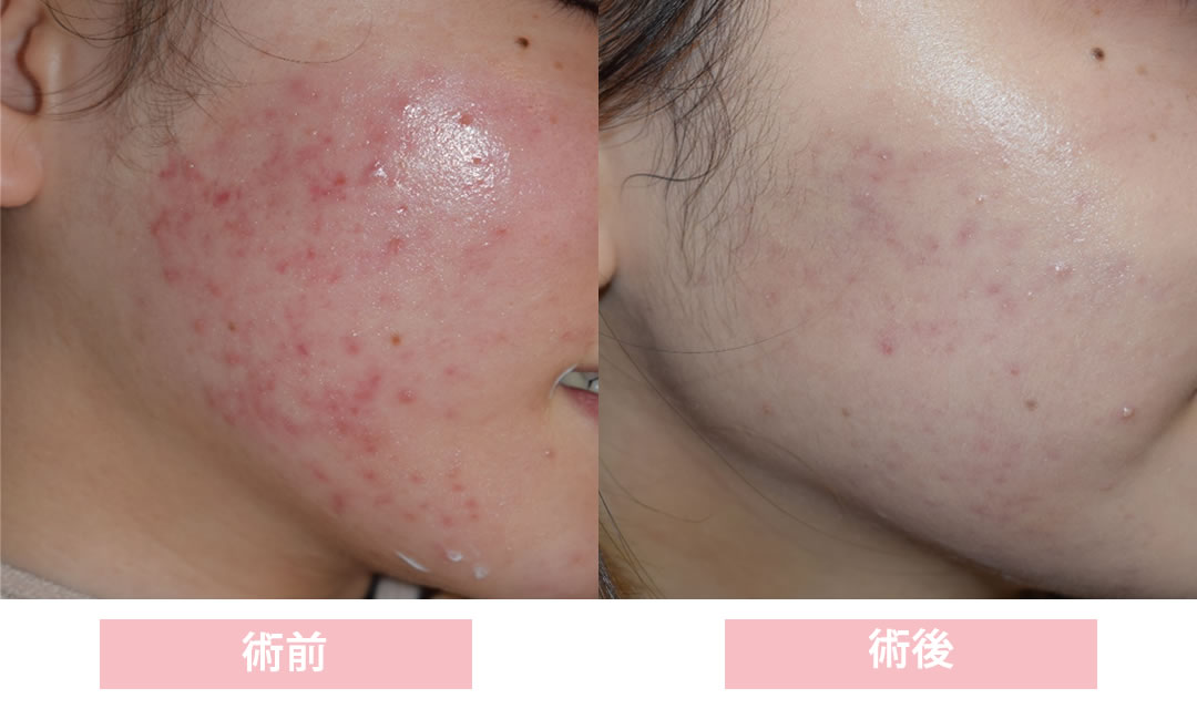 ダーマペンの所例写真