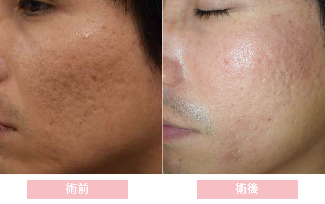 ダーマペンを3回施術した症例写真