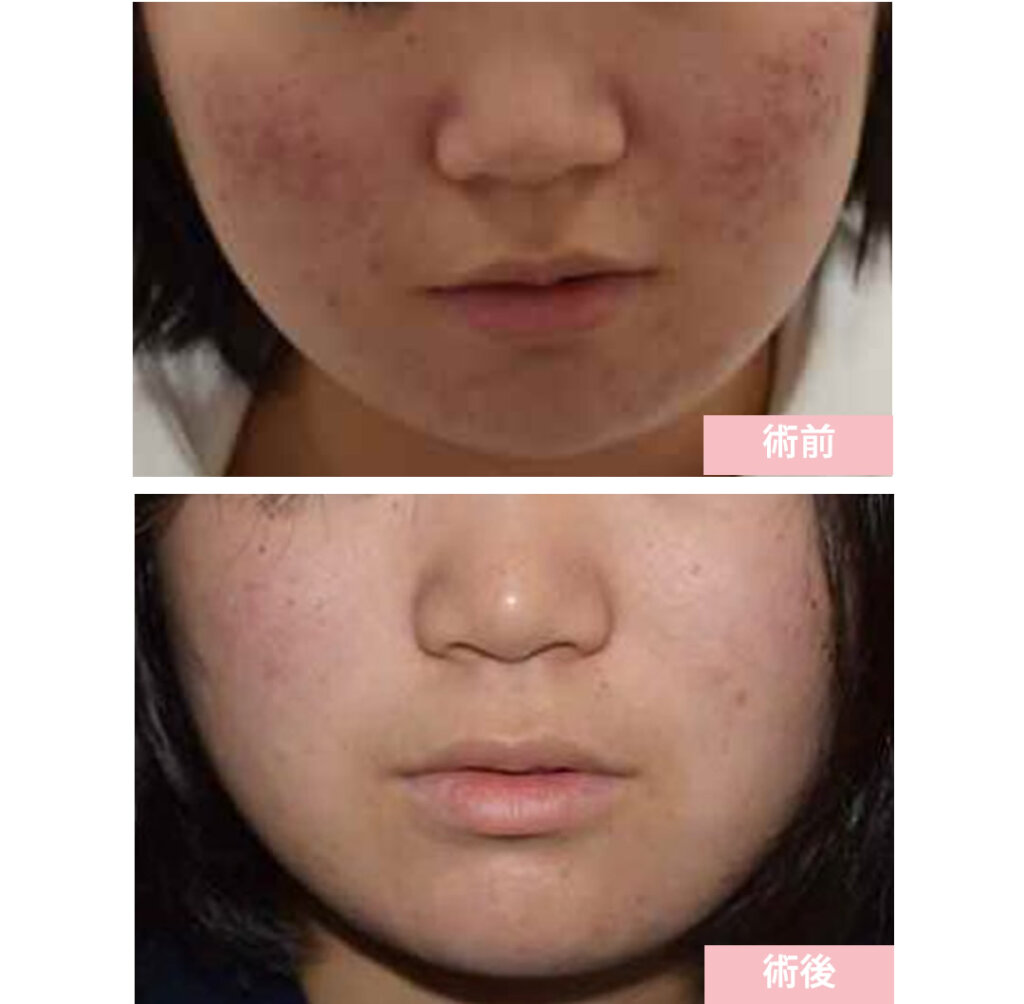 ベピオ＋ゼビアックス＋ビーソフテンの症例写真