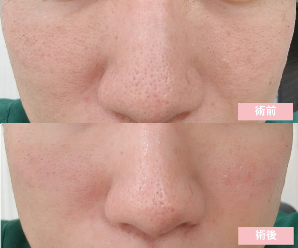 マッサージピール1回の症例写真