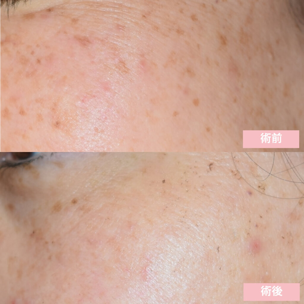 光治療1回の１週間後の症例