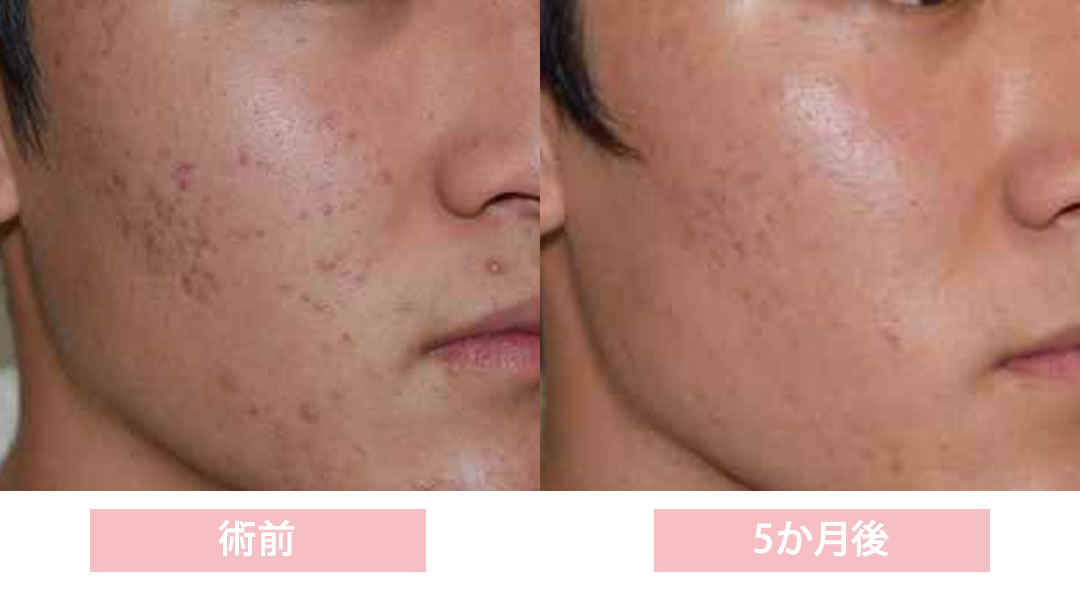 十味敗毒湯　５ヶ月