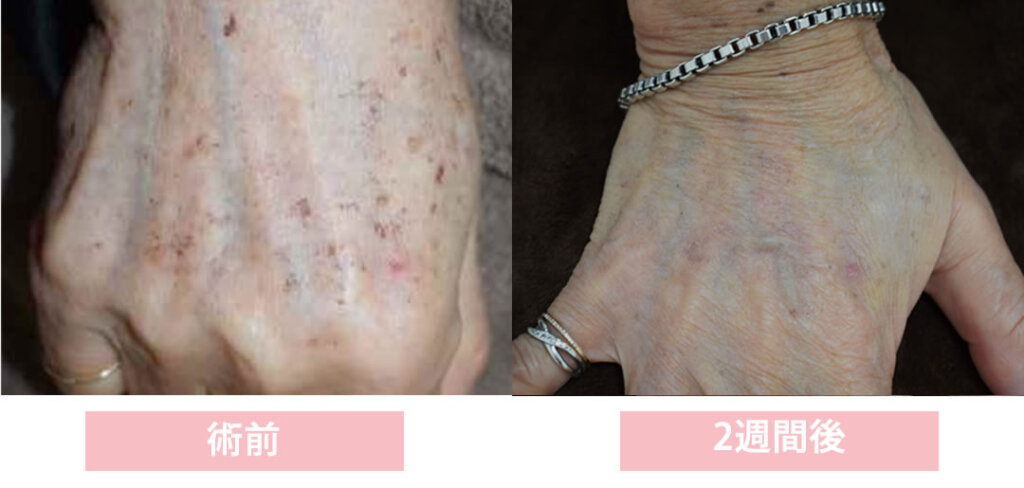 手のシミの光治療２週間後