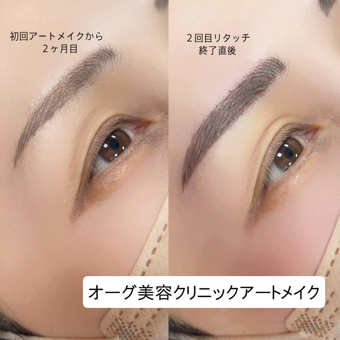 眉毛のアートメイクの症例写真 (2)