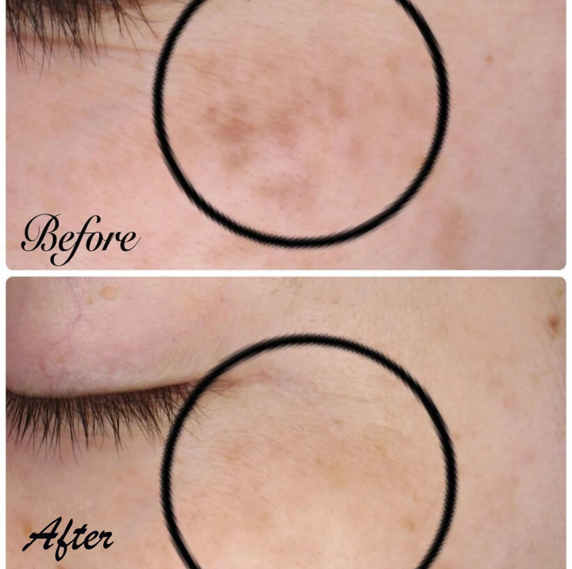 鹿児島のオーグ美容クリニックのADMの症例