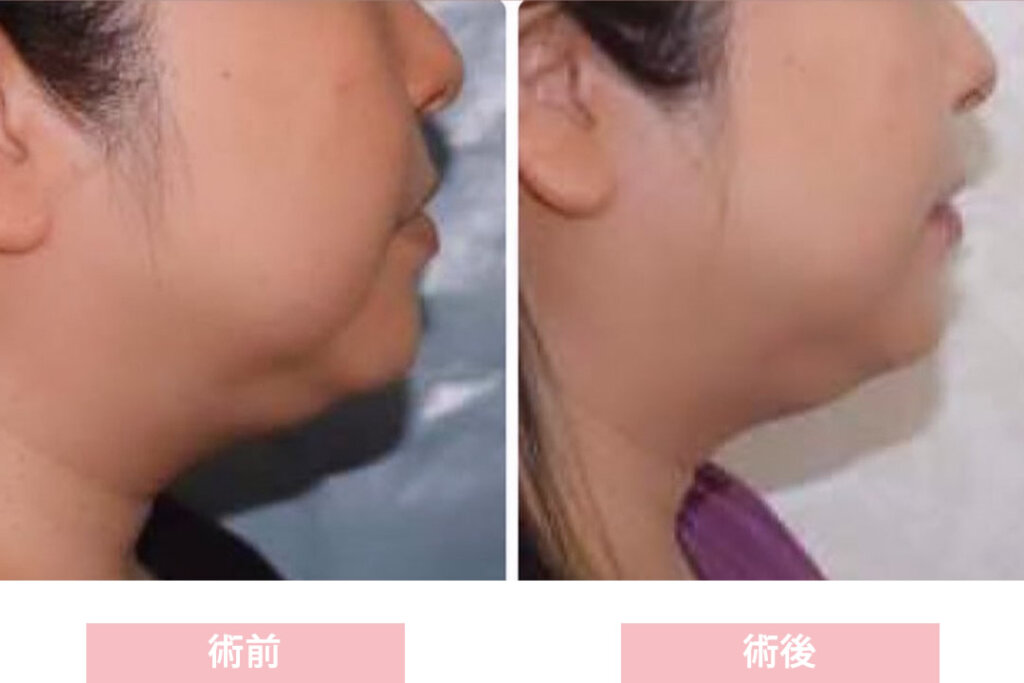 鹿児島のオーグ美容クリニックのハイフのダブロゴールドの症例写真