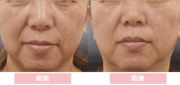 鹿児島のオーグ美容クリニックのヒアルロン酸のミニマムフィラーの症例