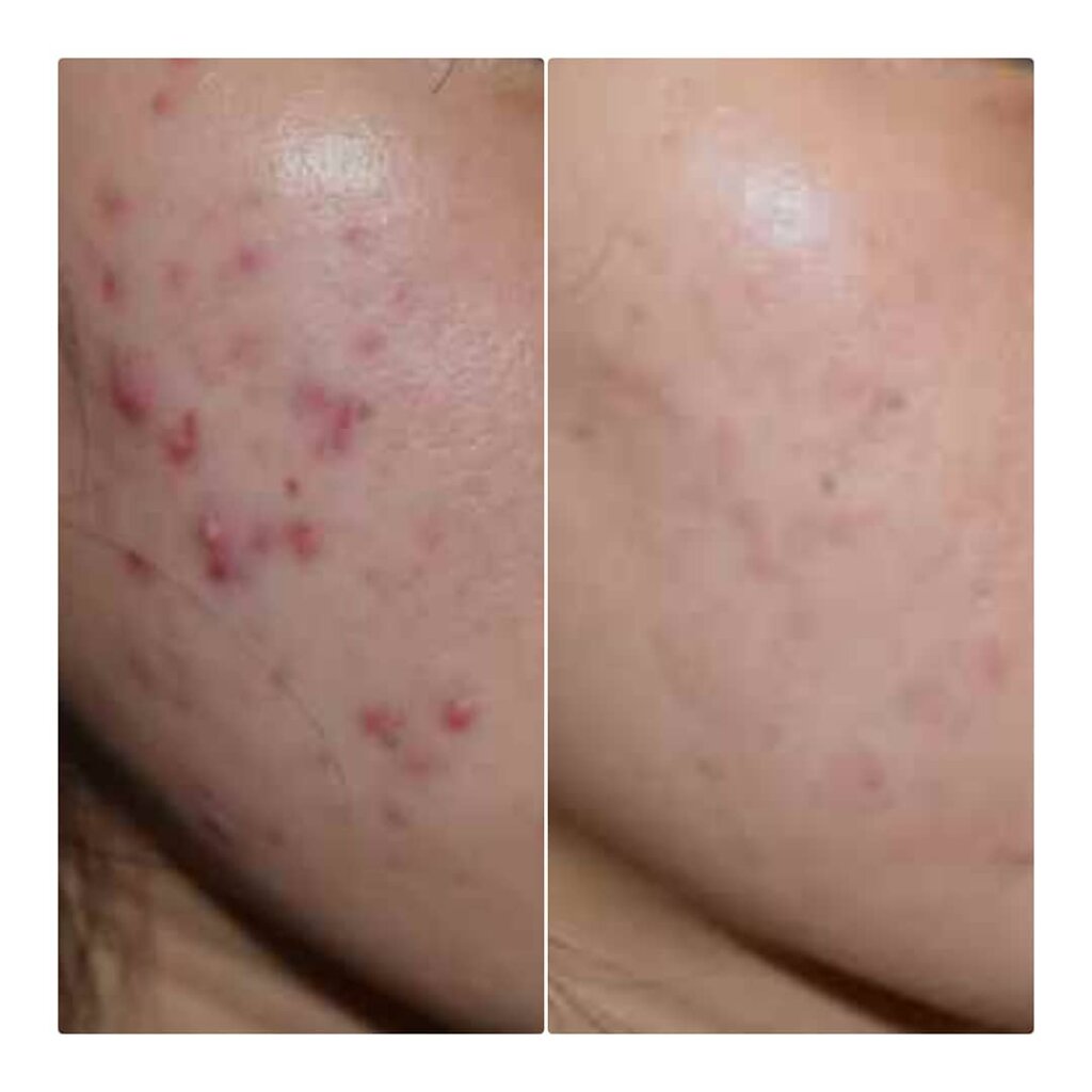 鹿児島のオーグ美容クリニックのレーザーフェイシャルとダーマペンでニキビを治療した症例