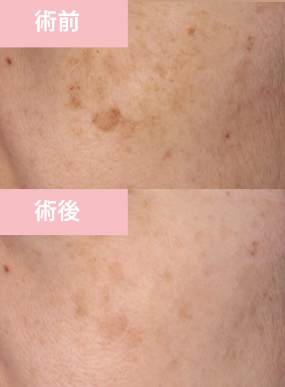 鹿児島のオーグ美容クリニックの肝斑の症例