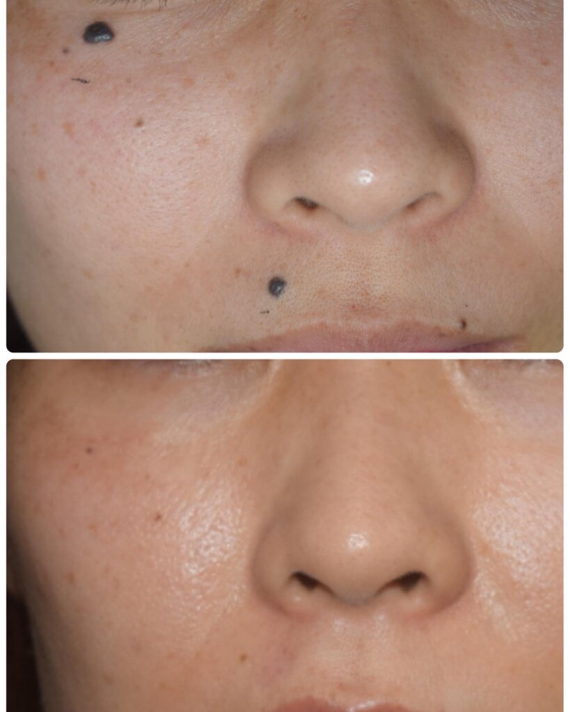鹿児島のオーグ美容クリニックの頬のホクロ除去の症例
