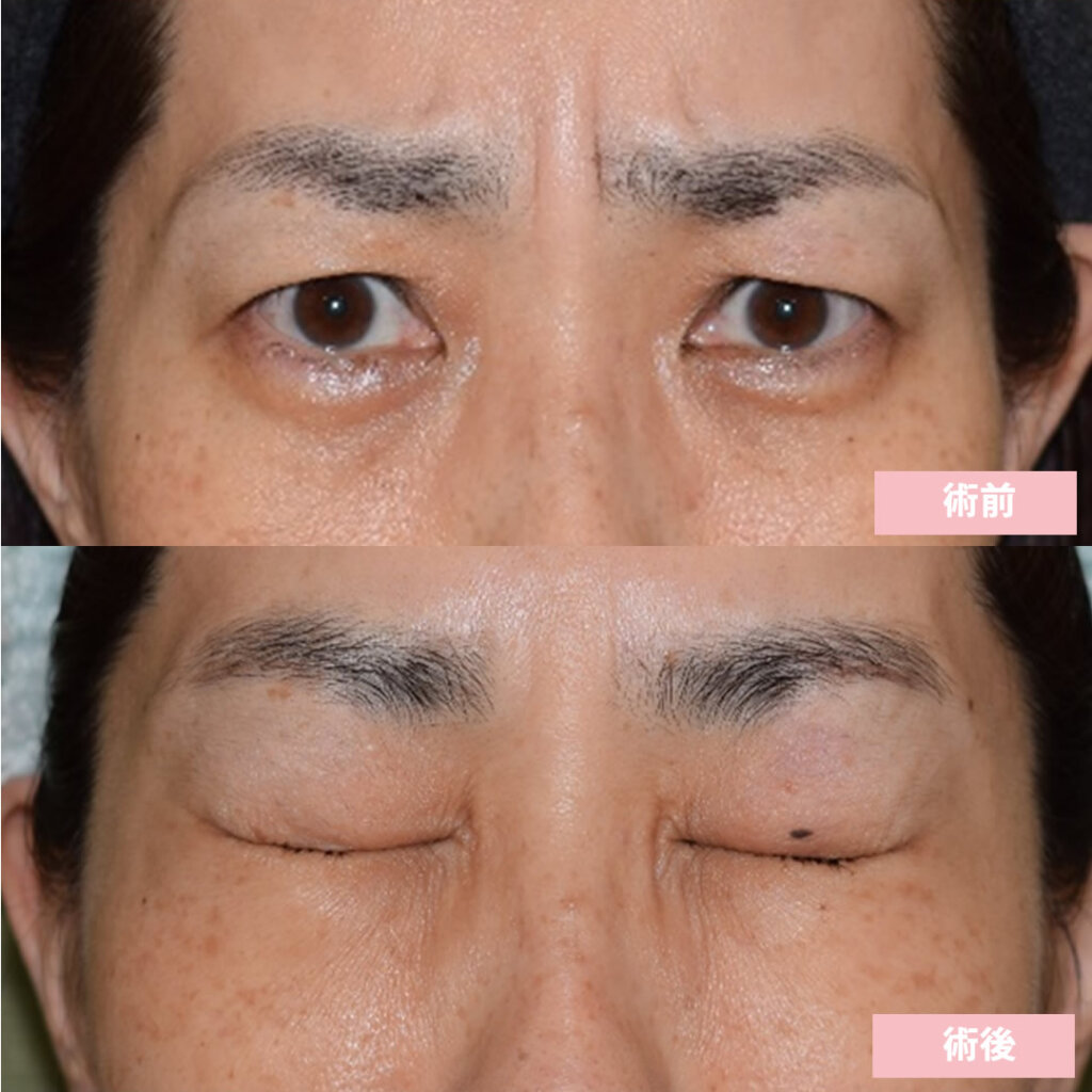 鹿児島のボトックス注射(目尻、眉間)の症例写真