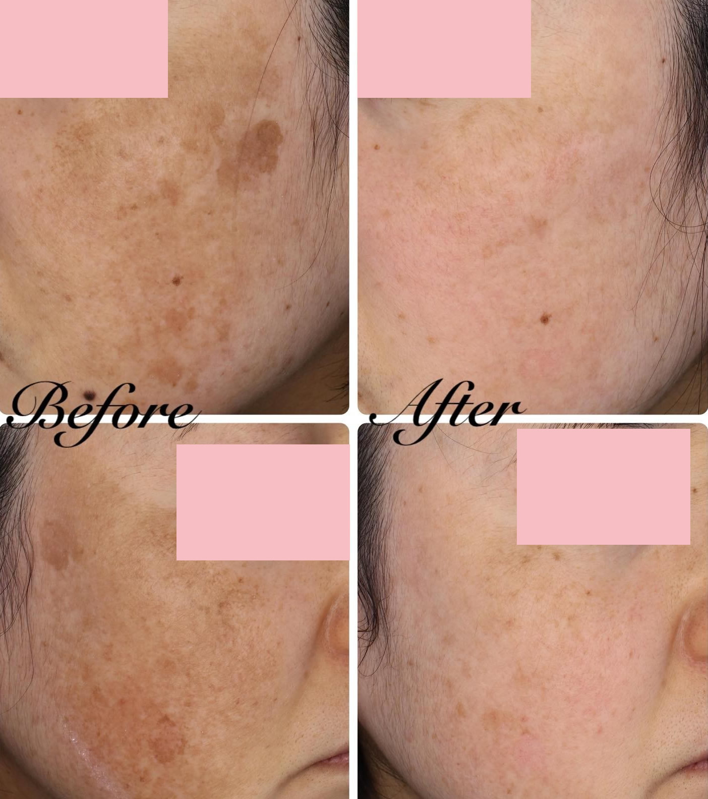 鹿児島の色素沈着（黒皮症）と老斑の症例写真