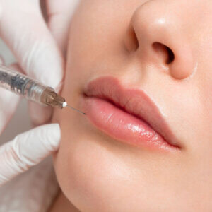 姶良市でヒアルロン酸を注射しているところ