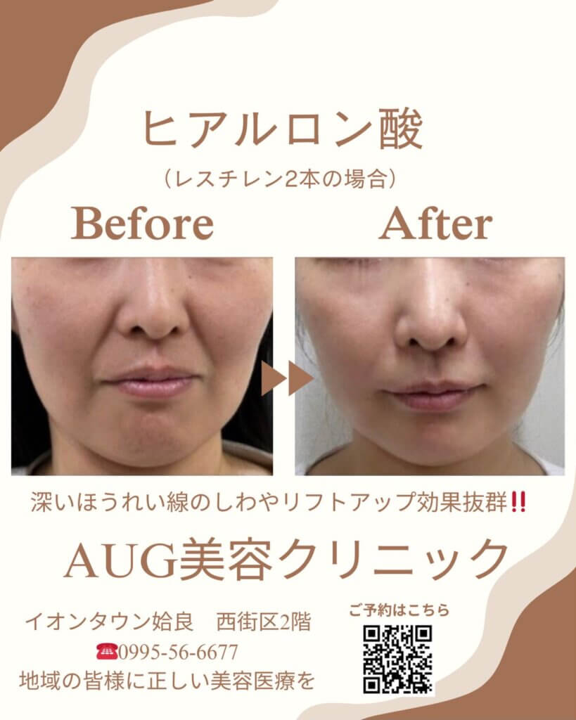 ヒアルロン酸の症例写真