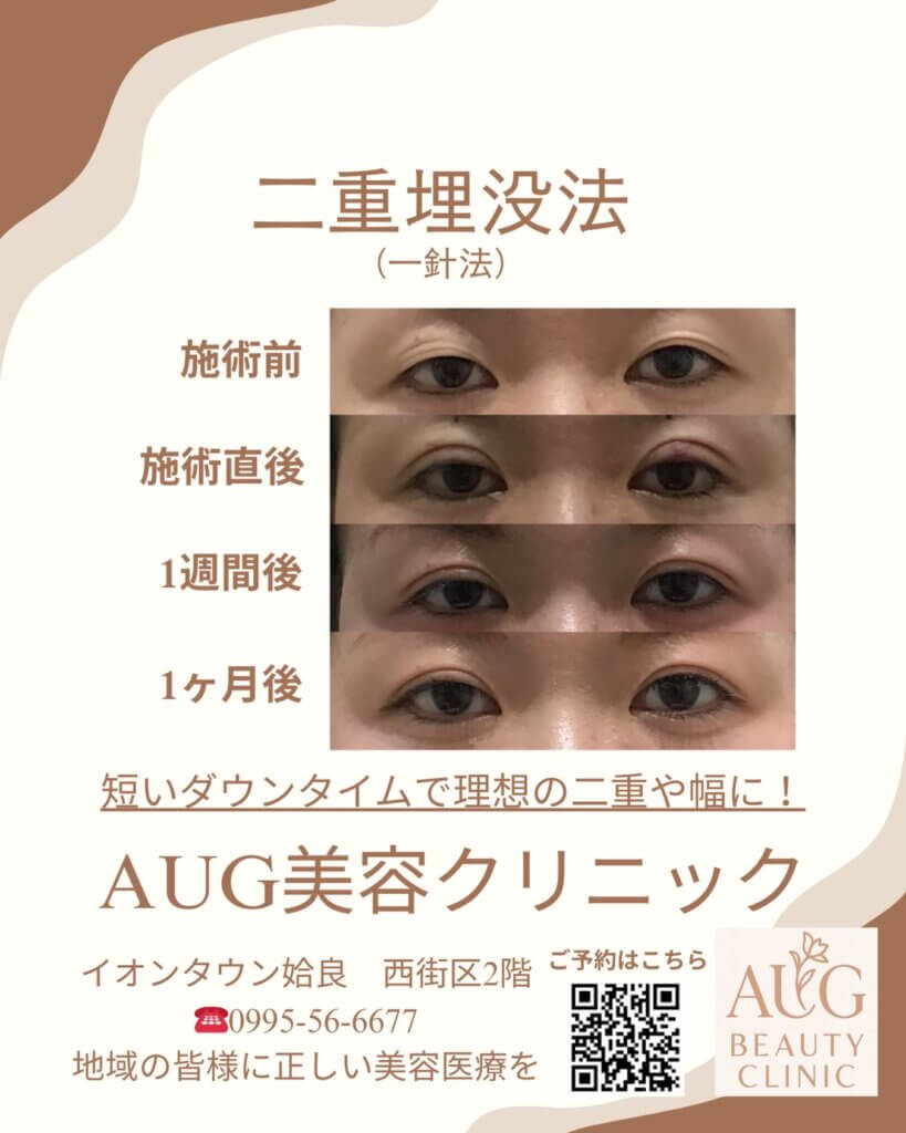 姶良市のオーグ美容クリニックの埋没法の症例